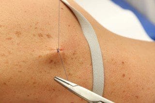 Surgical Dermatology Closing Surgical Dermatology Closing