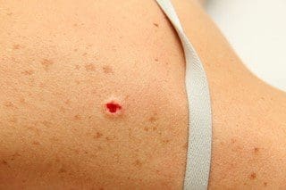 Surgical Dermatology Removal Surgical Dermatology Removal