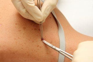Surgical Dermatology Excise